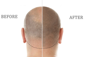 MIKROPIGMENTERING AV HÅRBOTTEN: EN ALTERNATIV LÖSNING FÖR ALOPECI