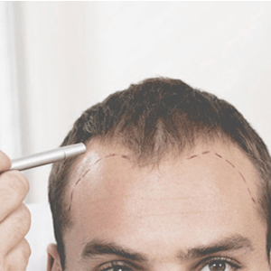 Implant de par cluj