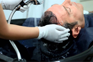 Précautions à prendre après une greffe de cheveux