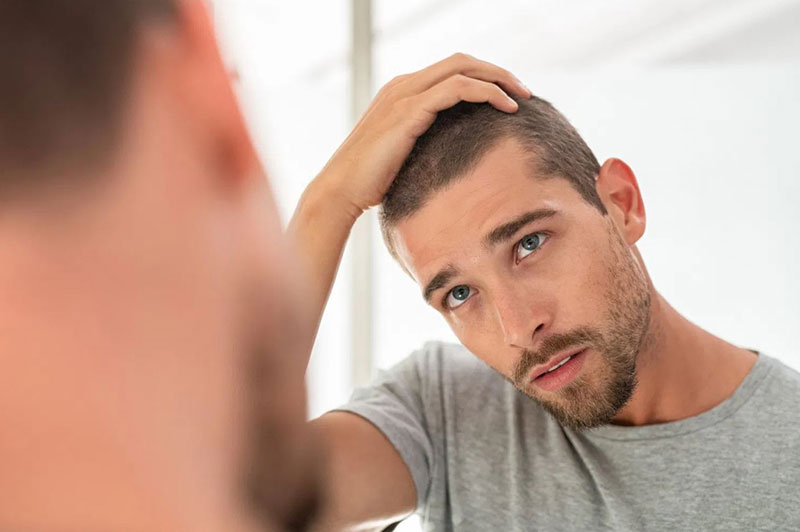 Alopecia difusa, ¿qué es, cuál es la causa y qué tratamiento tiene?
