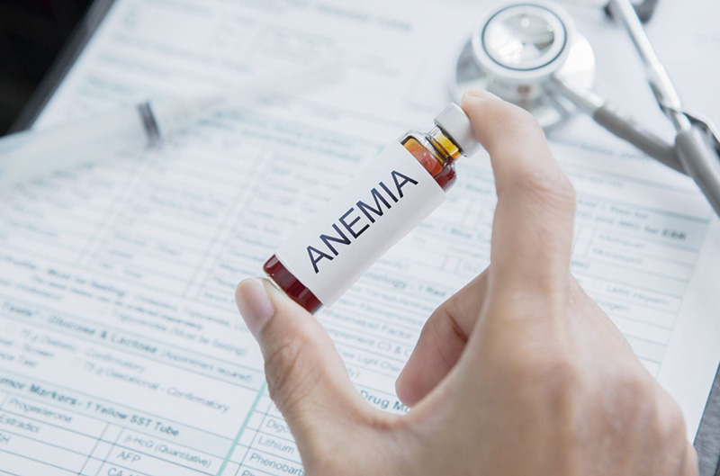Anemia y caída del pelo: causas y soluciones