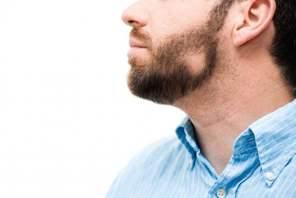 Qu'est ce qui peut causer la chute de cheveux auto-immune? Existe t-il un traitement?