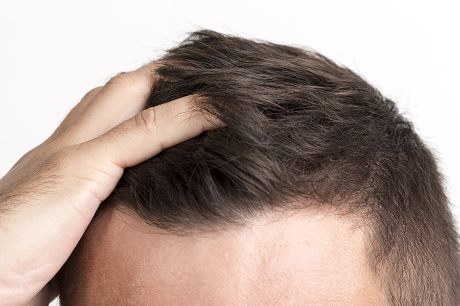 ¿Qué es la foliculitis del cuero cabelludo, y cómo eliminarla?