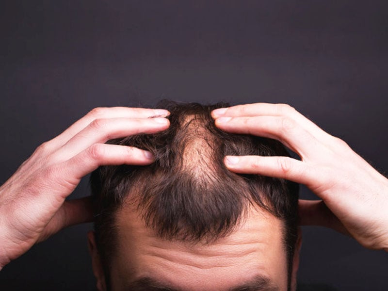 La chute de cheveux et le psoriasis, quels sont les causes, les signes et les traitements