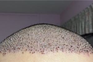 SÅRSKORPOR EFTER DIN HÅRTRANSPLANTATION