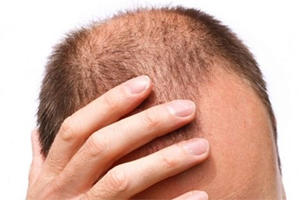 كيف تعرف ما إذا كنت على وشك الإصابة بالصلع، وكيف تمنع ذلك؟